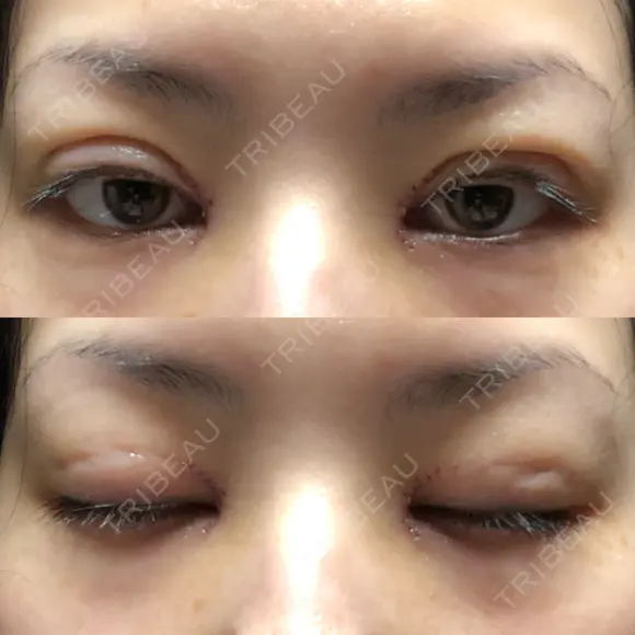 二重埋没 / 目頭切開 / 上まぶたの脂肪取り 十仁美容整形 DAY 0 メイン用