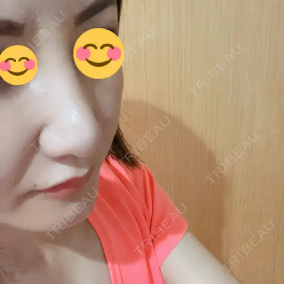 隆鼻術 / 鼻尖形成（切開） / 小鼻縮小（切開） / 軟骨移植 湘南美容クリニック 那覇院 DAY 12 メイン用