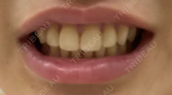 セラミック パール歯科医院 AFTER メイン用