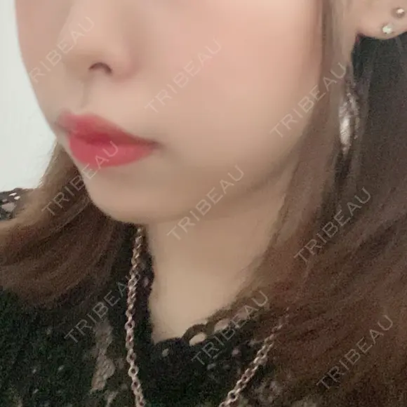 脂肪溶解注射（顔） 赤坂プレミアクリニック DAY 5 メイン用