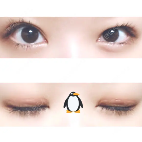 二重切開 神野美容形成外科クリニック DAY 104 メイン用