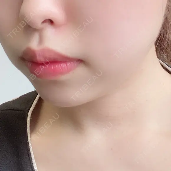 脂肪溶解注射（顔） 赤坂プレミアクリニック DAY 6 メイン用