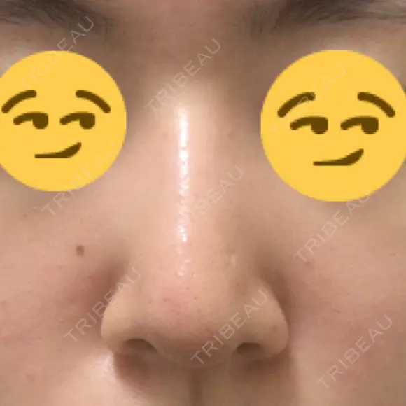 鼻尖縮小 / ヒアルロン酸注入（鼻） 東京ヒルズクリニック 新宿院 AFTER メイン用