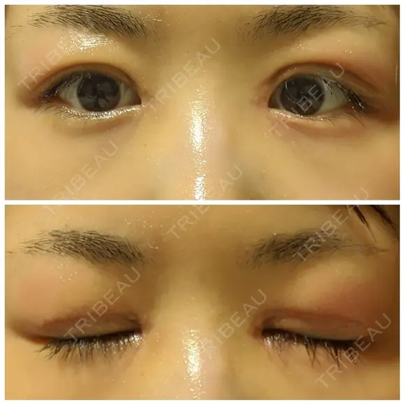 二重切開 / 目頭切開 / 眼瞼下垂（切開） / 目尻切開 湘南美容クリニック 大阪堺東院 DAY 13 メイン用