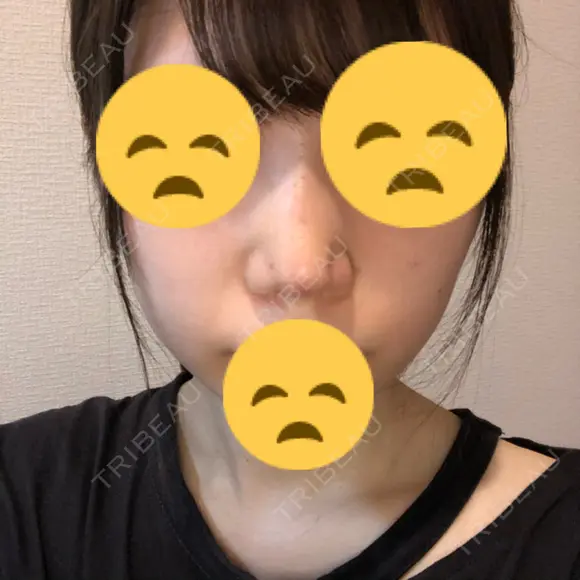 鼻尖縮小 東京ヒルズクリニック 新宿院 DAY 2 メイン用