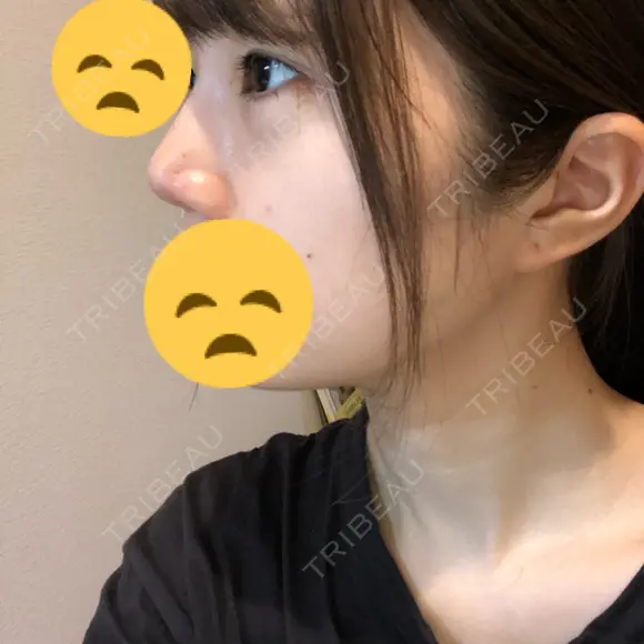 鼻尖縮小 東京ヒルズクリニック 新宿院 DAY 2 メイン用