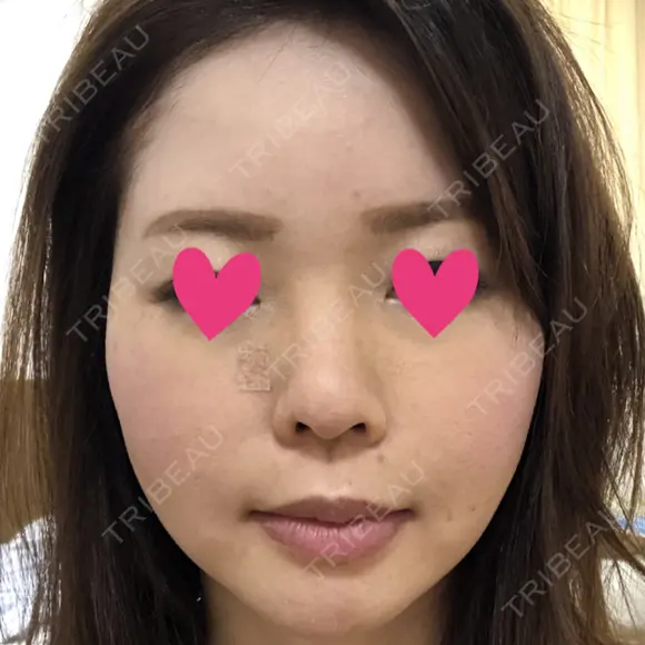 脂肪注入（輪郭） テラクリニック DAY 69 メイン用