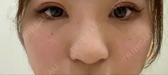 ヒアルロン酸注入（鼻） 銀座TAクリニック AFTER メイン用