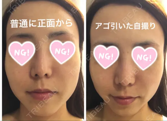 糸リフト / ボトックス（あご） / 肌ヒアルロン酸注入（たるみ・シワ改善） / ボトックス（口角） 湘南美容クリニック 秋葉原院 DAY 22 メイン用