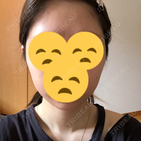 ボトックス（エラ・小顔） 東京ヒルズクリニック 新宿院 DAY 3 メイン用