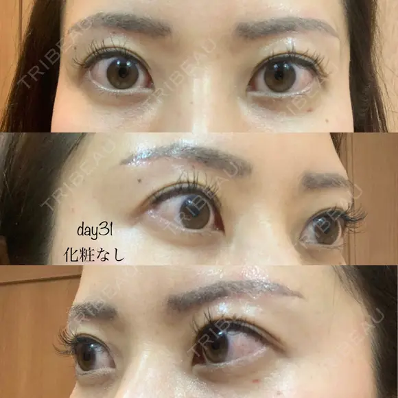 眉下切開 湘南美容クリニック 秋葉原院 DAY 31 メイン用