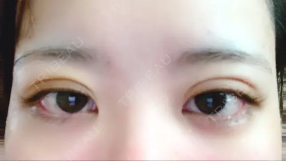 二重埋没 湘南美容クリニック 那覇院 DAY 5 メイン用