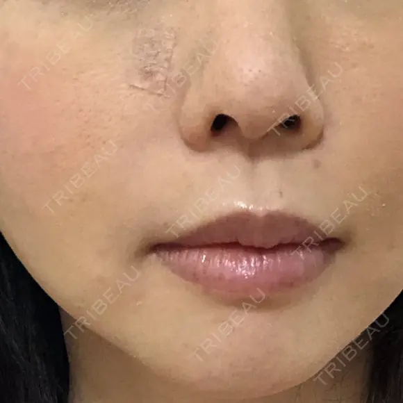 脂肪注入（輪郭） テラクリニック AFTER メイン用