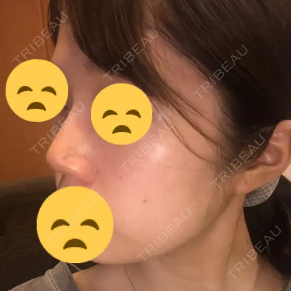 鼻尖縮小 東京ヒルズクリニック 新宿院 DAY 4 メイン用