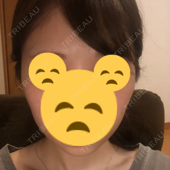 ボトックス（エラ・小顔） 東京ヒルズクリニック 新宿院 DAY 4 メイン用