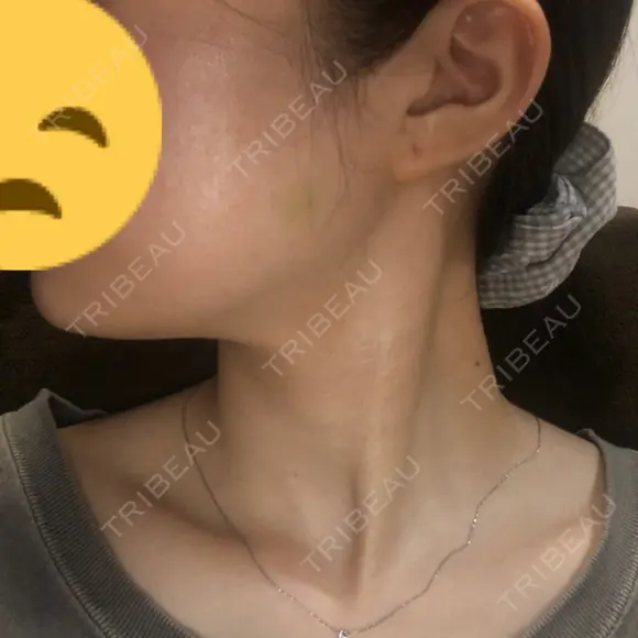 ボトックス（エラ・小顔） 東京ヒルズクリニック 新宿院 DAY 4 メイン用