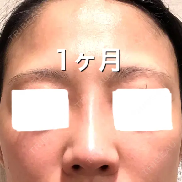 ヒアルロン酸注入（鼻） BIANCA銀座 AFTER メイン用