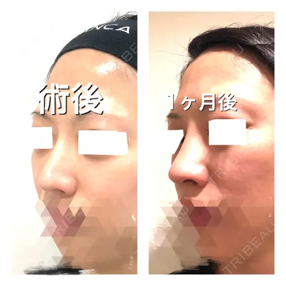 ヒアルロン酸注入（鼻） BIANCA銀座 DAY 32 メイン用
