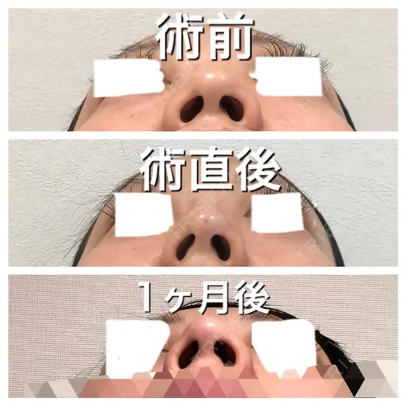 ヒアルロン酸注入（鼻） BIANCA銀座 DAY 32 メイン用