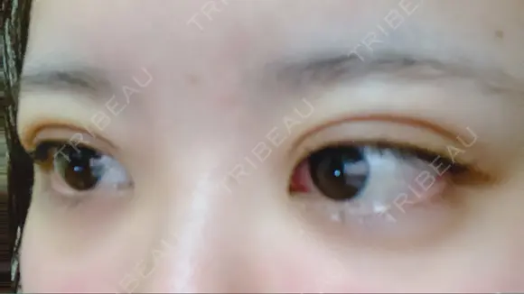 二重埋没 湘南美容クリニック 那覇院 DAY 6 メイン用