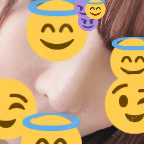 鼻尖形成（切開） / 鼻中隔延長（切開） / 軟骨移植 / 鼻翼基部形成（貴族手術） HANABI整形外科 DAY 16 メイン用