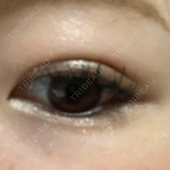 二重埋没 / 脂肪吸引（顔） 表参道スキンクリニック 表参道院 DAY 12 メイン用