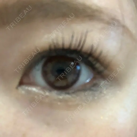 二重埋没 / 脂肪吸引（顔） 表参道スキンクリニック 表参道院 DAY 14 メイン用