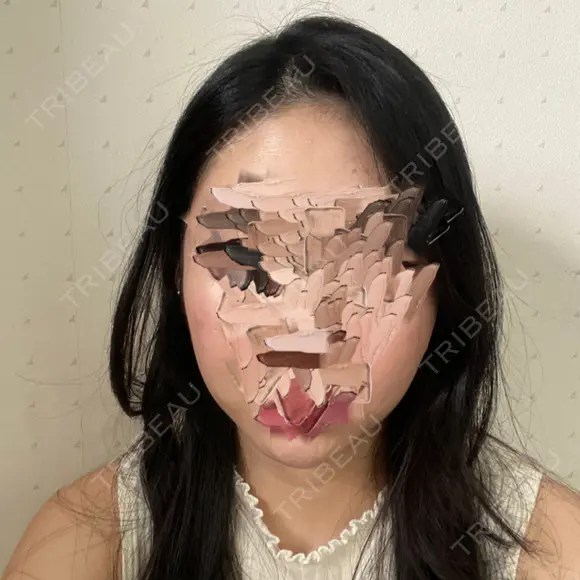 骨削り（頬） ボンディ美容整形外科（旧リオン整形外科） DAY 132 メイン用