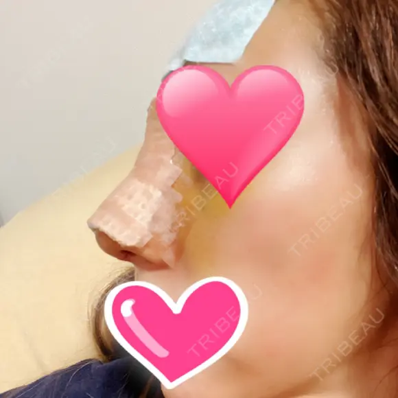 鼻中隔延長（切開） / 骨切幅寄せ / ワシ鼻修正・ハンプ切除 表参道スキンクリニック 表参道院 DAY 5 メイン用