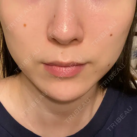 ハイフ（顔） Zetith Beauty Clinic 銀座院 AFTER メイン用