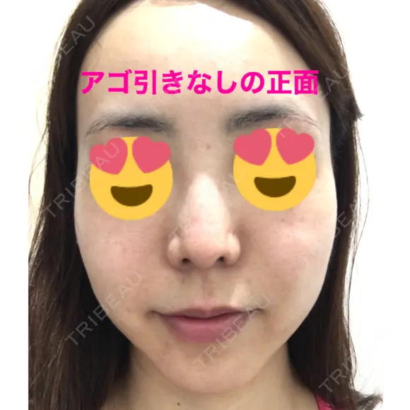 糸リフト / ボトックス（あご） / 肌ヒアルロン酸注入（たるみ・シワ改善） / ボトックス（口角） 湘南美容クリニック 秋葉原院 DAY 28 メイン用