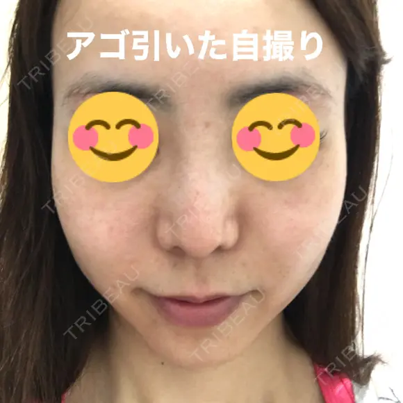 糸リフト / ボトックス（あご） / 肌ヒアルロン酸注入（たるみ・シワ改善） / ボトックス（口角） 湘南美容クリニック 秋葉原院 DAY 28 メイン用