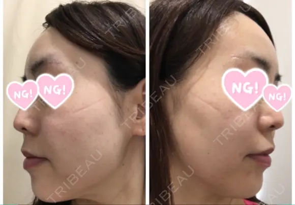 糸リフト / ボトックス（あご） / 肌ヒアルロン酸注入（たるみ・シワ改善） / ボトックス（口角） 湘南美容クリニック 秋葉原院 DAY 28 メイン用