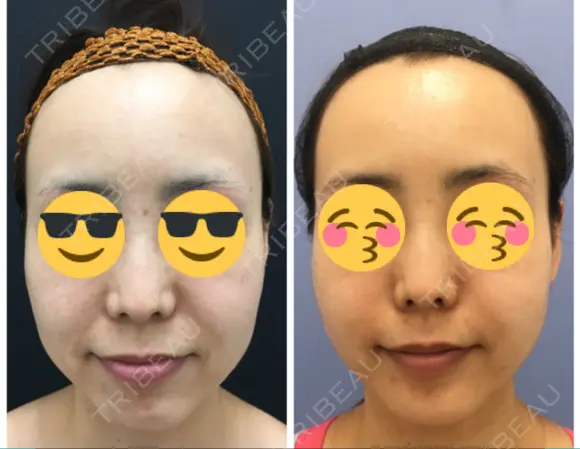 糸リフト / ボトックス（あご） / 肌ヒアルロン酸注入（たるみ・シワ改善） / ボトックス（口角） 湘南美容クリニック 秋葉原院 DAY 28 メイン用