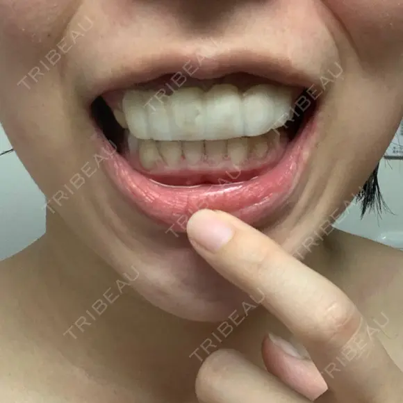 ガミースマイル手術 / 矯正（ワイヤー） / セラミック / ホワイトニング ラ・ブージュデンタルクリニック DAY 1 メイン用