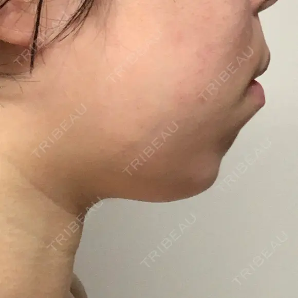 ガミースマイル手術 / 矯正（ワイヤー） / セラミック / ホワイトニング ラ・ブージュデンタルクリニック DAY 1 メイン用