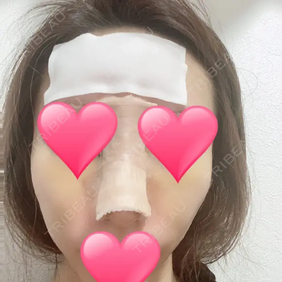 鼻中隔延長（切開） / 骨切幅寄せ / ワシ鼻修正・ハンプ切除 表参道スキンクリニック 表参道院 DAY 7 メイン用