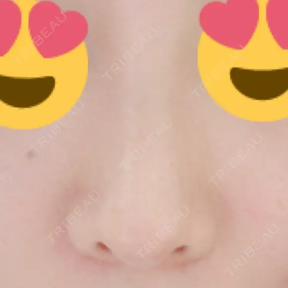 鼻尖形成（切開） / 鼻中隔延長（切開） / 軟骨移植 / 鼻翼基部形成（貴族手術） HANABI整形外科 DAY 17 メイン用