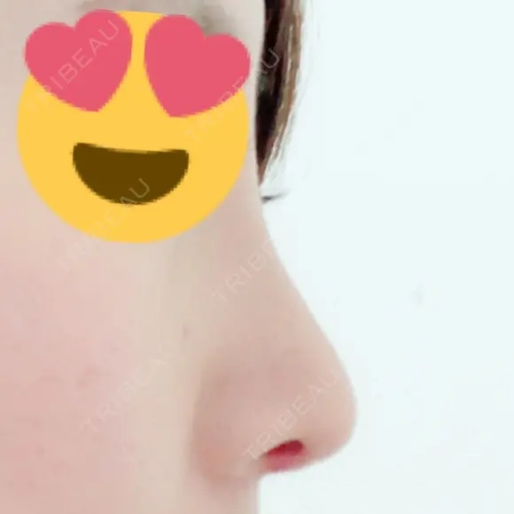 鼻尖形成（切開） / 鼻中隔延長（切開） / 軟骨移植 / 鼻翼基部形成（貴族手術） HANABI整形外科 DAY 17 メイン用