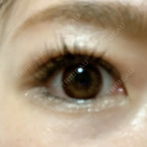 二重埋没 / 脂肪吸引（顔） 表参道スキンクリニック 表参道院 DAY 18 メイン用