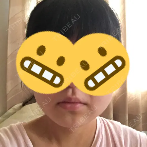 その他（輪郭） 品川美容外科 静岡院 DAY 70 メイン用