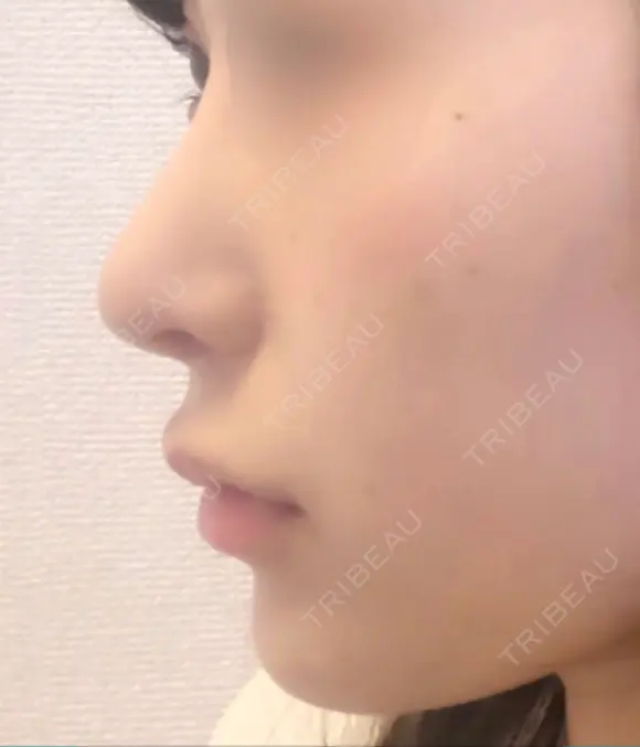 隆鼻術 / 鼻尖形成（切開） / 鼻中隔延長（切開） / 小鼻縮小（切開） / 軟骨移植 HANABI整形外科 DAY 249 メイン用