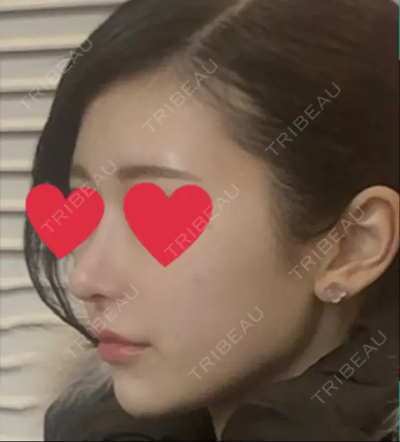 隆鼻術 / 鼻尖形成（切開） / 鼻中隔延長（切開） / 小鼻縮小（切開） / 軟骨移植 HANABI整形外科 DAY 85 メイン用