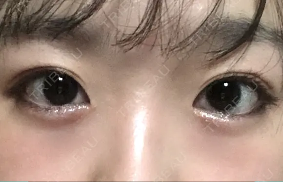 ボトックス（エラ・小顔） / 脂肪溶解注射（顔） / ヒアルロン酸注入（唇） / ボトックス（口角） id美容クリニック 銀座院 DAY 4 メイン用