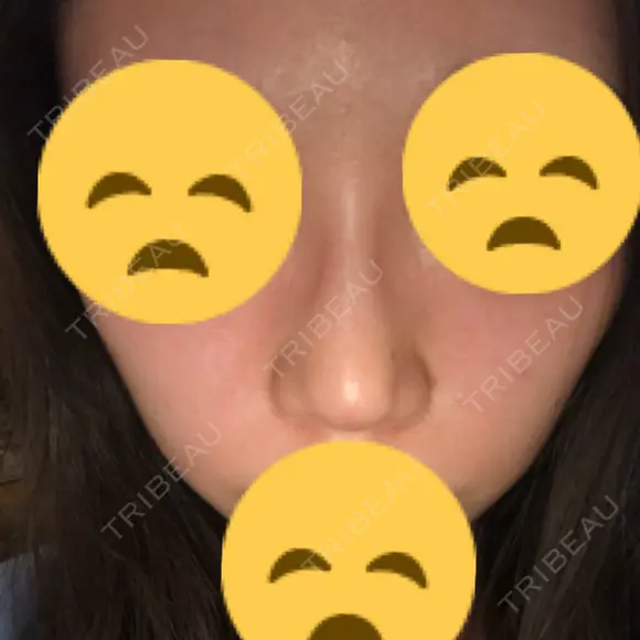 鼻尖縮小 東京ヒルズクリニック 新宿院 AFTER メイン用