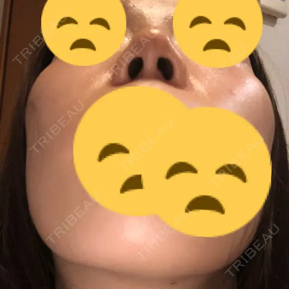 鼻尖縮小 東京ヒルズクリニック 新宿院 DAY 11 メイン用