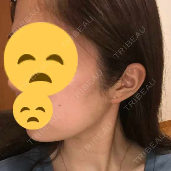 ボトックス（エラ・小顔） 東京ヒルズクリニック 新宿院 DAY 11 メイン用