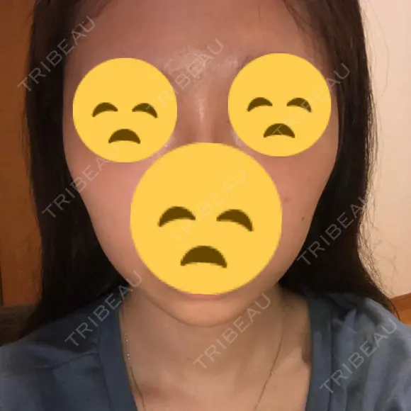 ボトックス（エラ・小顔） 東京ヒルズクリニック 新宿院 DAY 11 メイン用