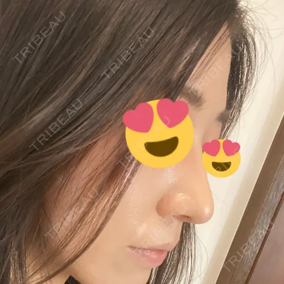 鼻尖形成（切開） / 鼻中隔延長（切開） / 軟骨移植 表参道スキンクリニック 表参道院 AFTER メイン用