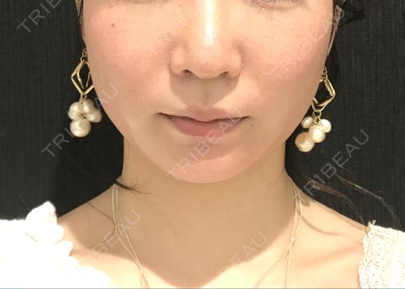脂肪吸引（顔） / メーラーファット除去 湘南美容クリニック 秋葉原院 AFTER メイン用